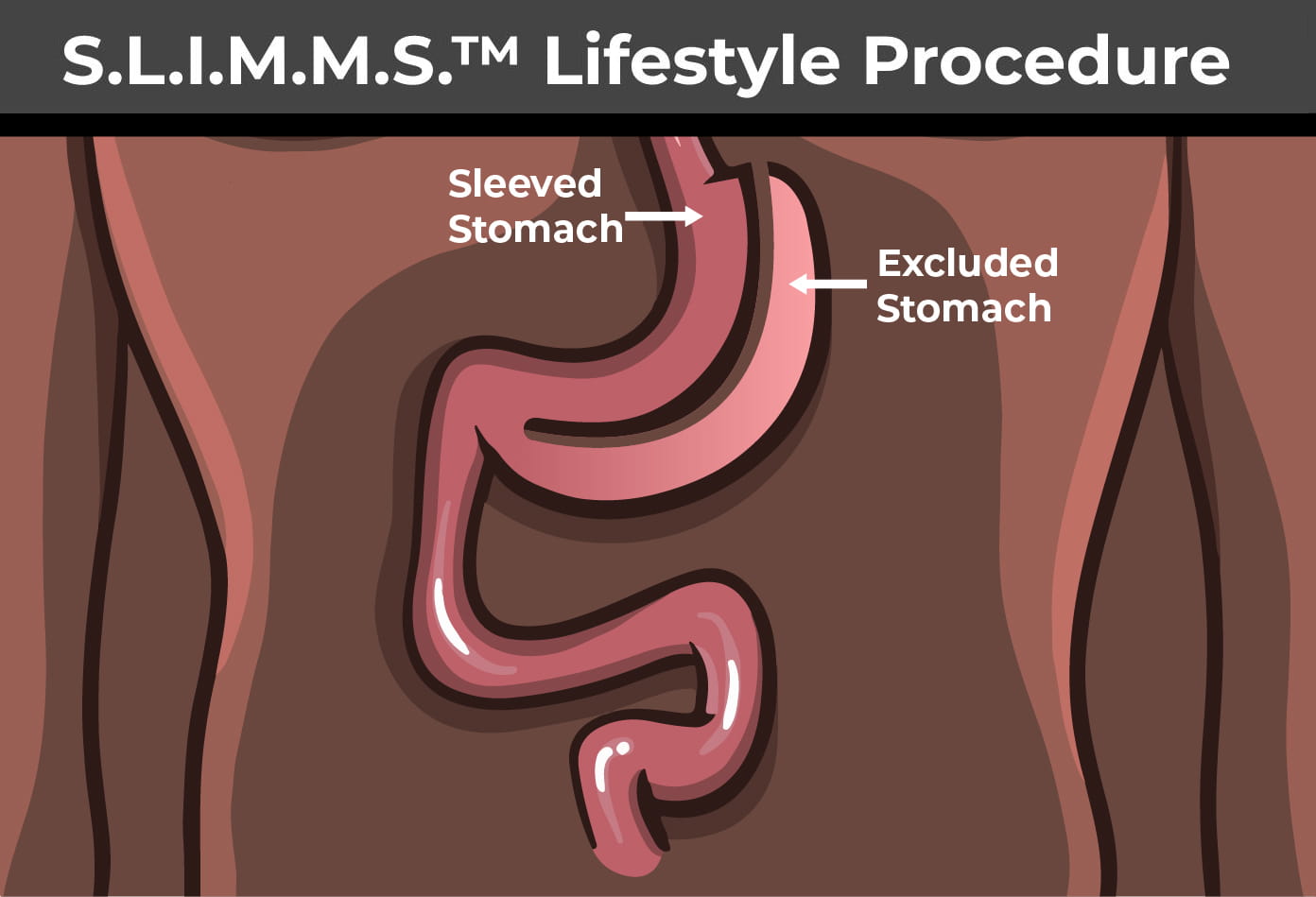 S.L.I.M.M.S.™-Lifestyle Procedure